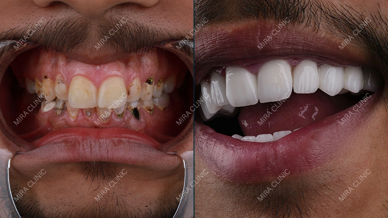 Before and After: Real Crown, Bridge or Implant Result